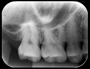 一般的な歯科用レントゲン