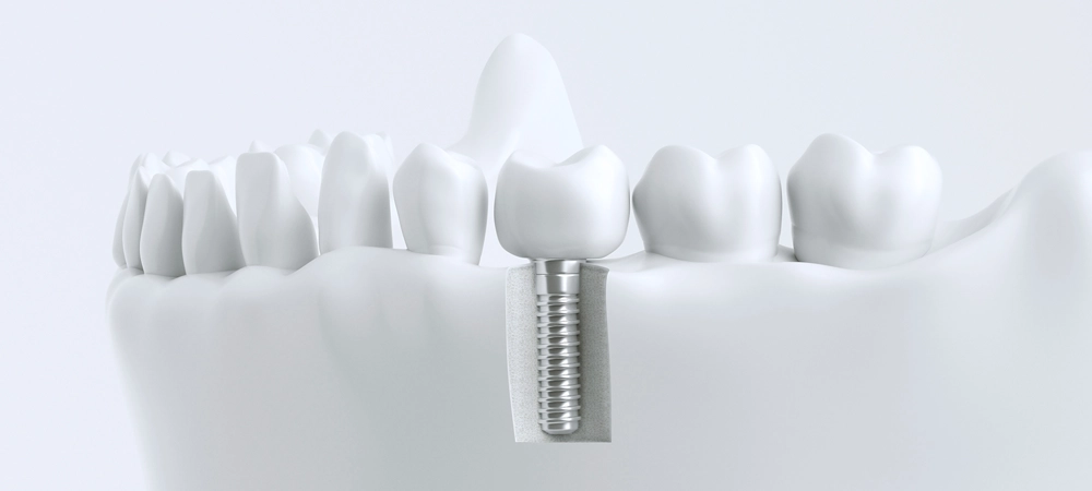 インプラント治療のご案内