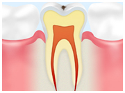 初期のむし歯（ＣＯ）