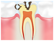 象牙質のむし歯（Ｃ２）