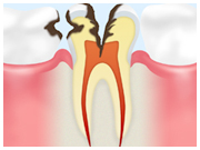 神経まで進行したむし歯（Ｃ３）
