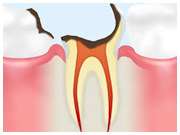 歯根まで進行したむし歯（Ｃ４）