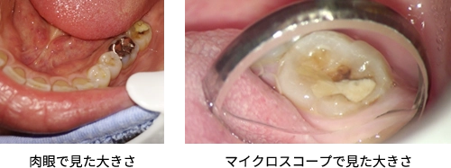 精度の高い修復治療