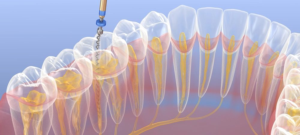 しもふり橋デンタルクリニックの根管治療